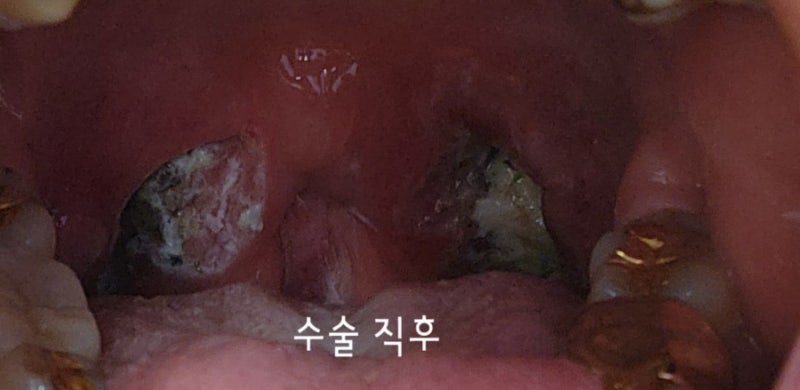 삼성병원 편도제거수술 후기 편도결석 ,편도염, 편도궤양
