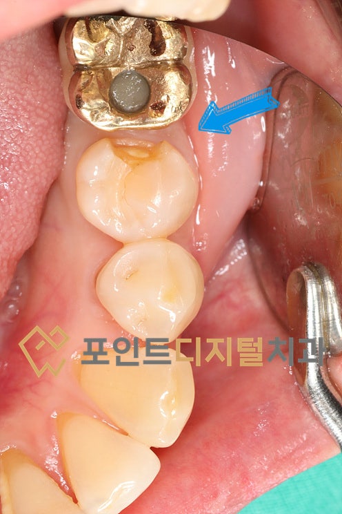  [탕정치과]  크라운이나 인레이 대신 레진으로 마무리한 케이스 / 천안 아산