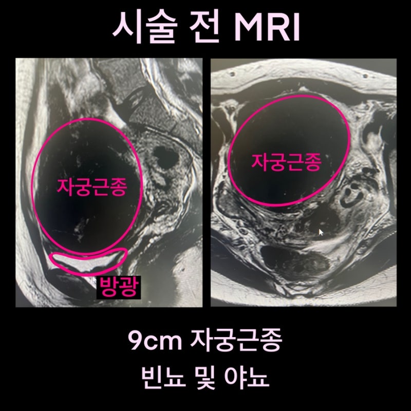 자궁근종과 소변