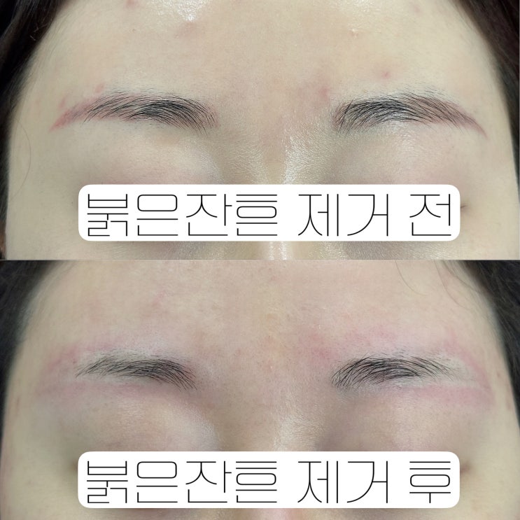 천안 망한 눈썹 문신 제거의 종착지 여기 천안 망한 눈썹 문신 제거의 종착지 여기