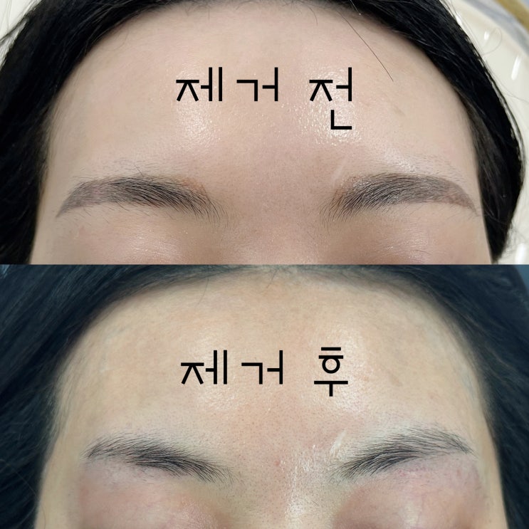  천안 망한 눈썹 문신 제거의 종착지 여기