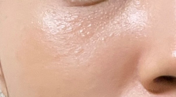 한관종 아그네스 내돈내산 솔직 치료 후기 (3회 치료 가격, 통증, 다운타임, 치료 후 도드라짐....