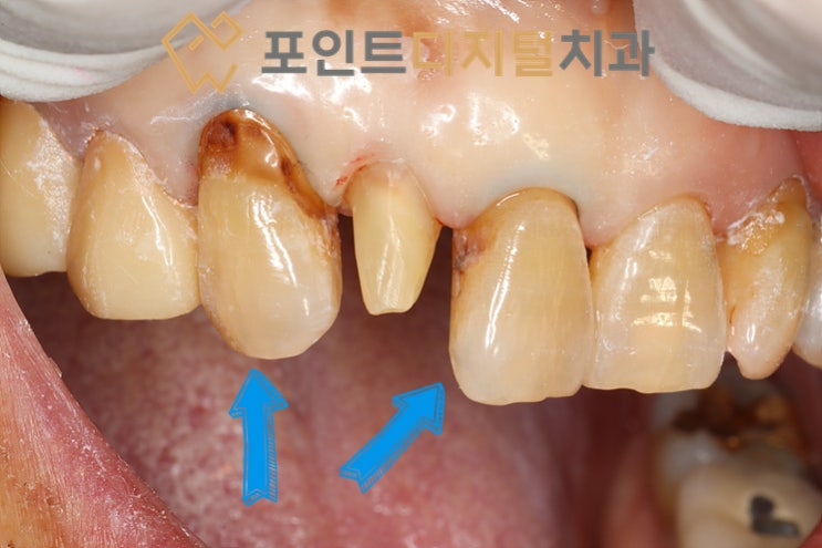 [탕정치과] 신기한 레진 옴니크로마(Omnichroma) 치경부우식 케이스 / 천안 아산
