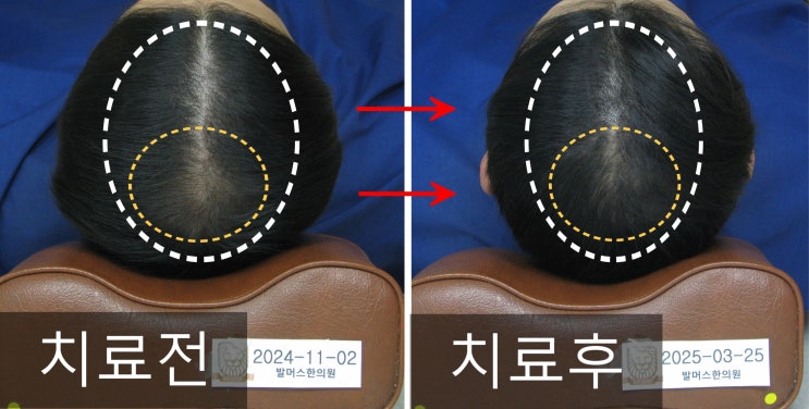  탈모는 무조건 유전때문인걸까? 유전 이외에 안드로겐성 탈모의 주요 위험 인자는? (+홍대 남자탈모 사례)
