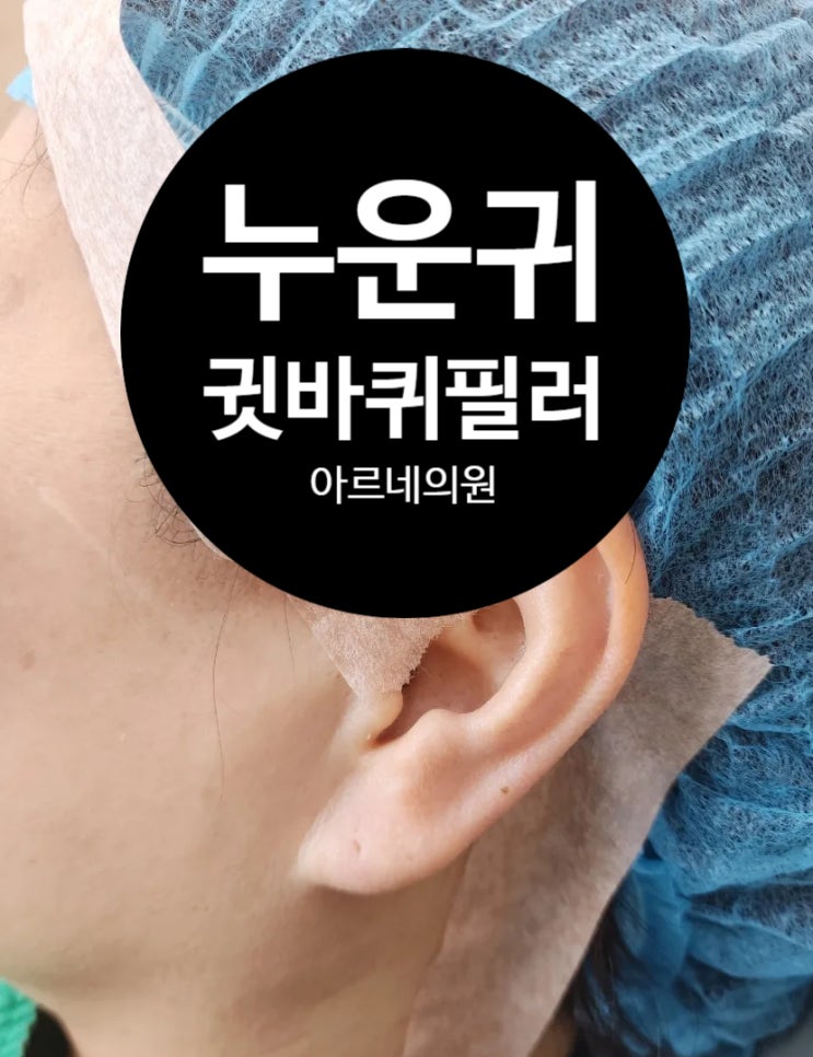  누운 귀필러 귓바퀴 귓불필러 가격 용량 통증 후기 부작용 설명 아르네의원
