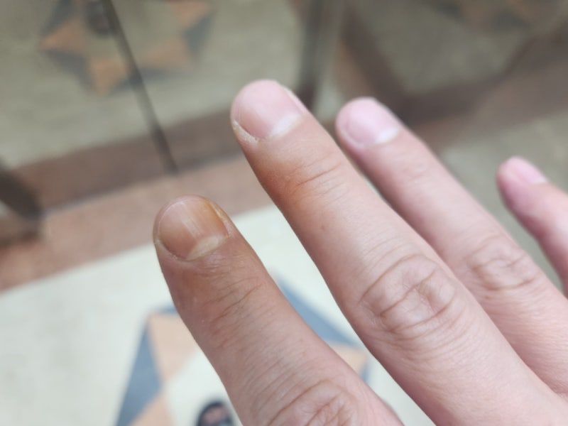 흡연자 손가락에 생긴 니코틴 제거 방법_나의 사례