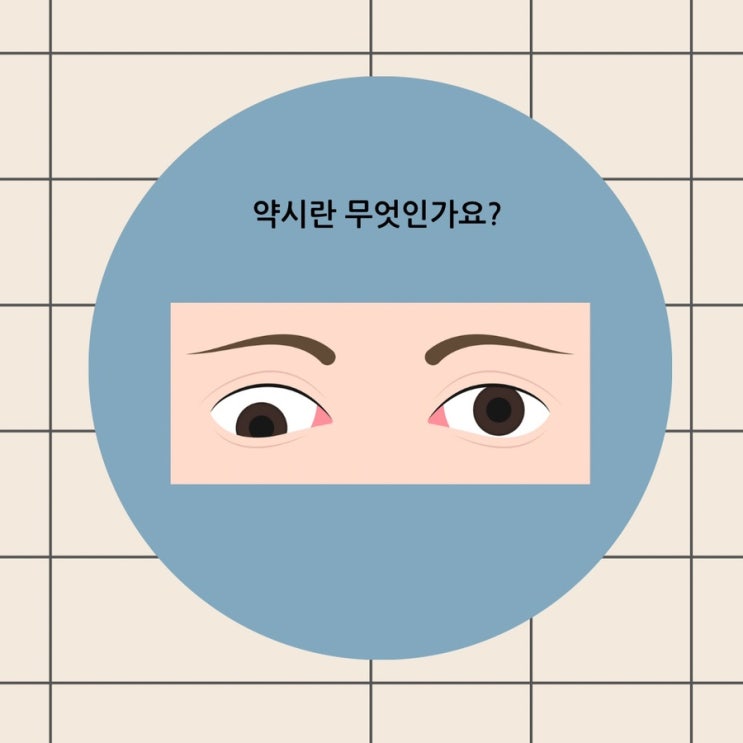 약시 뜻 증상 사시 부등시 가림치료