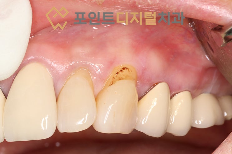  [탕정치과]  신기한 레진 옴니크로마(Omnichroma) 치경부마모 케이스 / 천안 아산