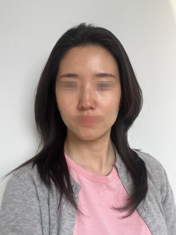  [에토좀PTT+제네시스 레이저] 4차 내돈내산 기록
