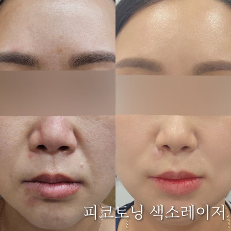 창원 피부과 피코토닝 받고 피부톤 맑아짐 전후사진