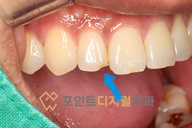  [탕정치과]  옴니크로마(Omnichroma) 레진 케이스 하나더(앞니 치아파절) / 천안 아산