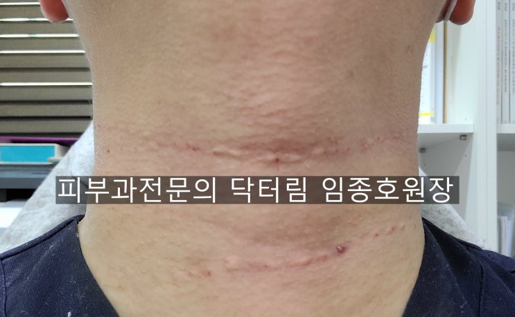  목주름 관리 시술 [가로목주름, 세로목주름, 잔주름]
