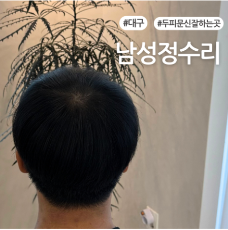 대구 정수리 탈모커버, 커버도 중요하지만, 더 중요한것.