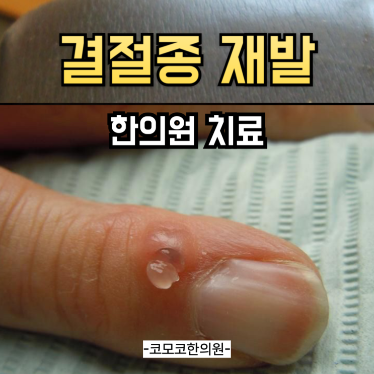  손가락 결절종, 재발 잦은 이유와 수술없는 치료법