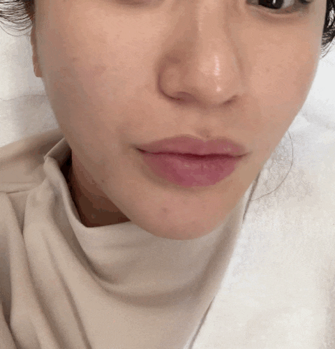  청담동 피부과 안티안의원 리프팅 비비엘히어로 레이져 효과 가격