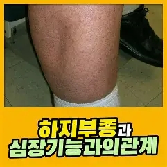 임신 후기의 하지 부종