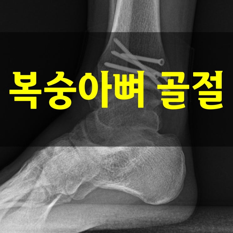  복숭아뼈 골절 비수술이라면 초기 안정이 더 중요한 이유