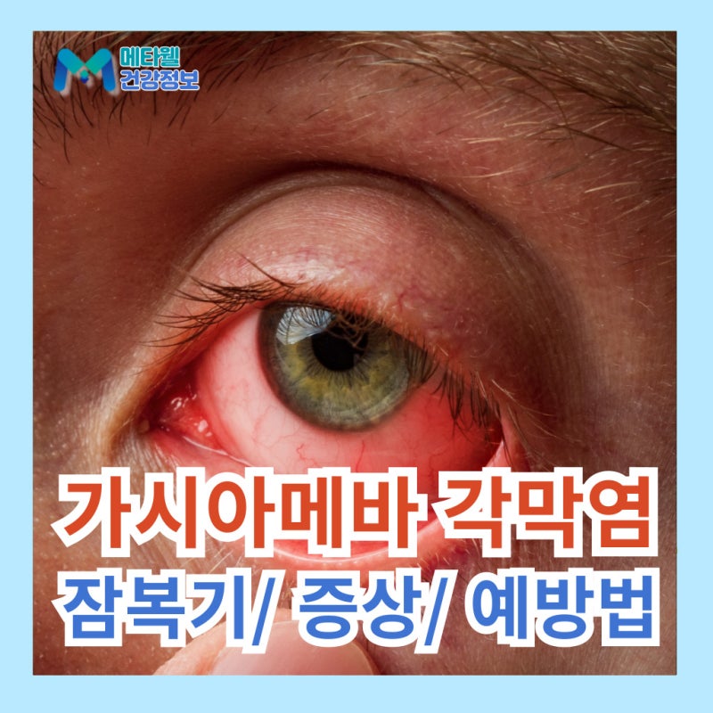 가시아메바 각막염 실명 가능? 원인 증상 치료 잠복기 예방법