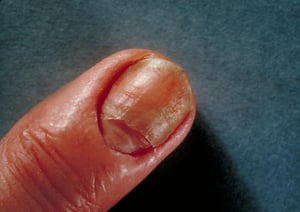 만성 점막피부칸디다증(Chronic Mucocutaneous Candidiasis)