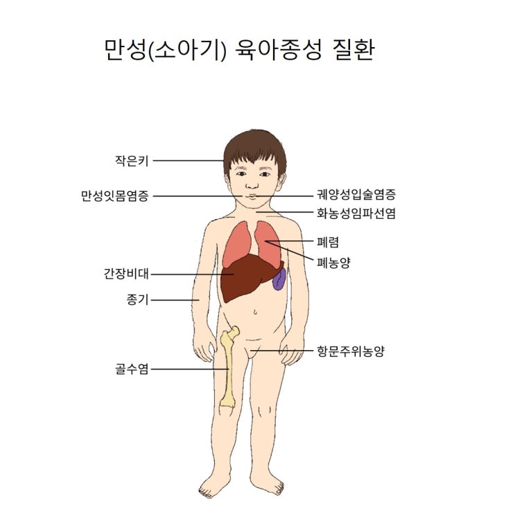 만성 육아종 질환(CGD)