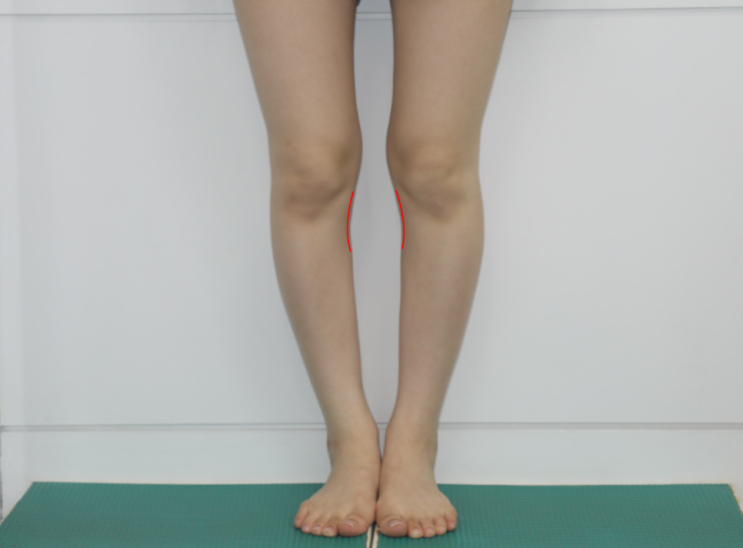 휜다리를 해결할 수 있는 명확한 기준