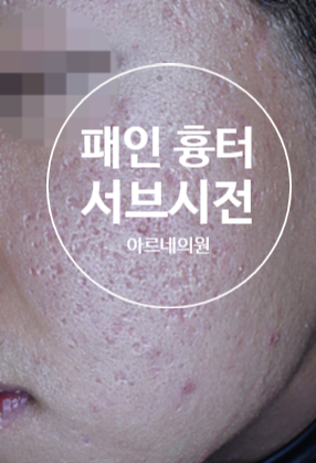  여드름 흉터 치료 과정 효과 - 왜 여러 번 받아도 효과가 없을까요?