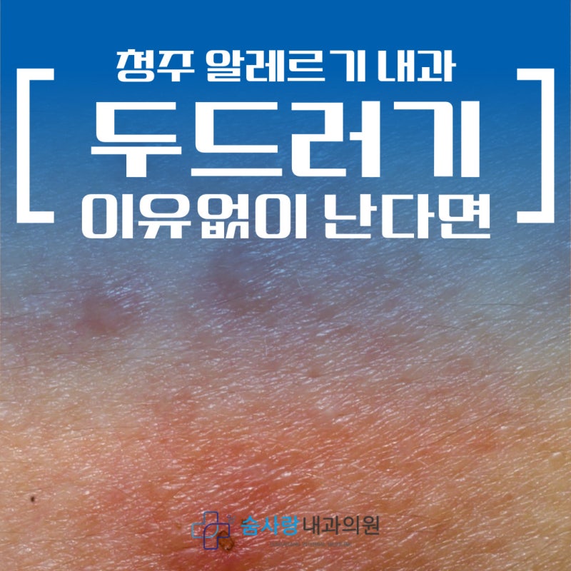 청주 알레르기 내과 이유없이 두드러기, 같은 시간에 반복된다면?