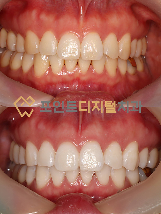  [탕정치과]  오스템 뷰티스 전문가 치아 미백 / 천안 아산 불당 배방