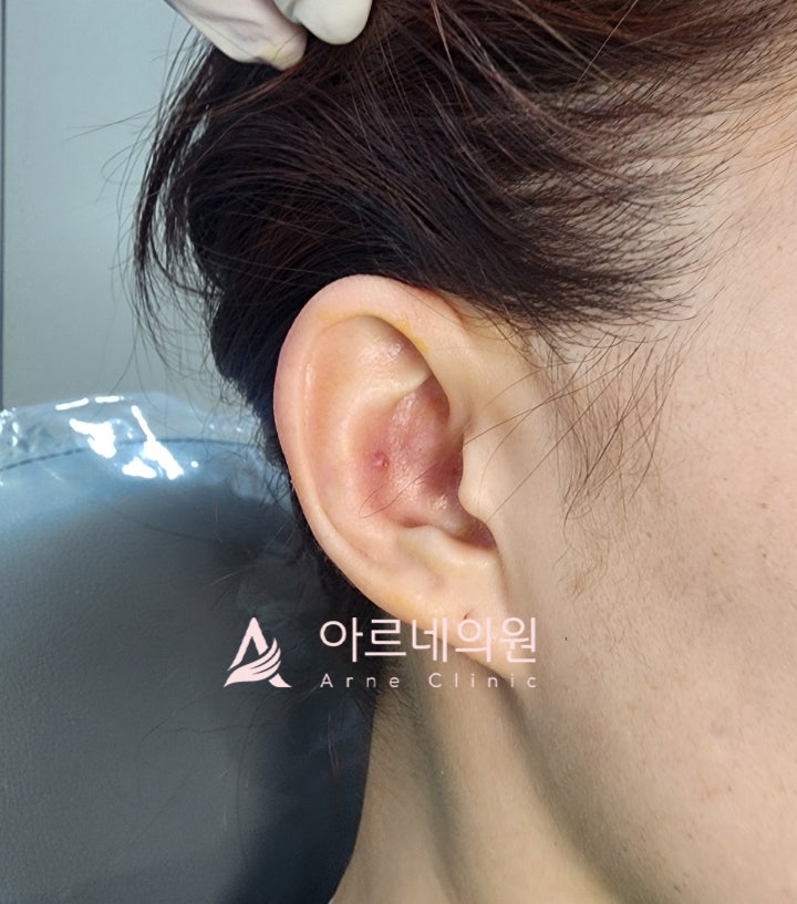  신논현 아르네의원 귀필러 용량 부작용 가격 후기