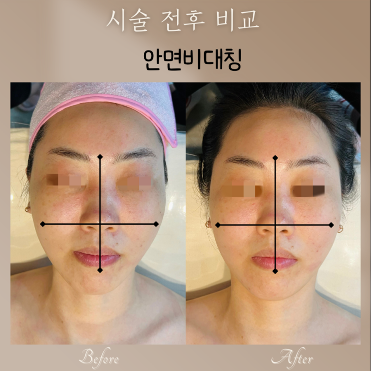  부산피부관리 안면비대칭 윤곽관리, 왜 꼭 받아야 할까?