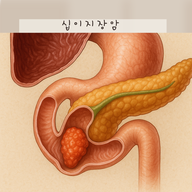 십이지장암 증상 초기에 알기어려워요! 1기 2기 3기 4기 생존율 예후 총정리