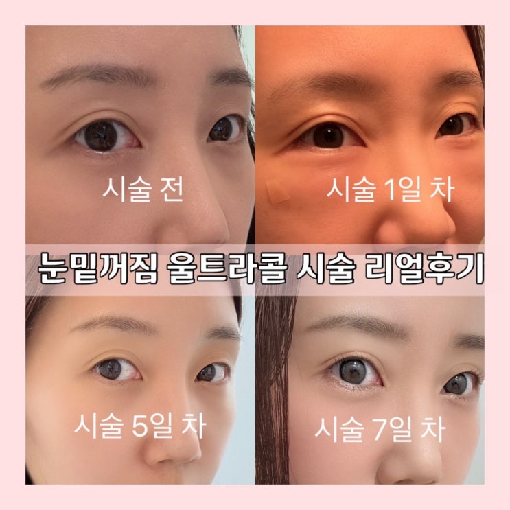 눈 밑 꺼짐 울트라콜200 2cc 시술 7일 전후 비교 붓기 관리 방법 부작용