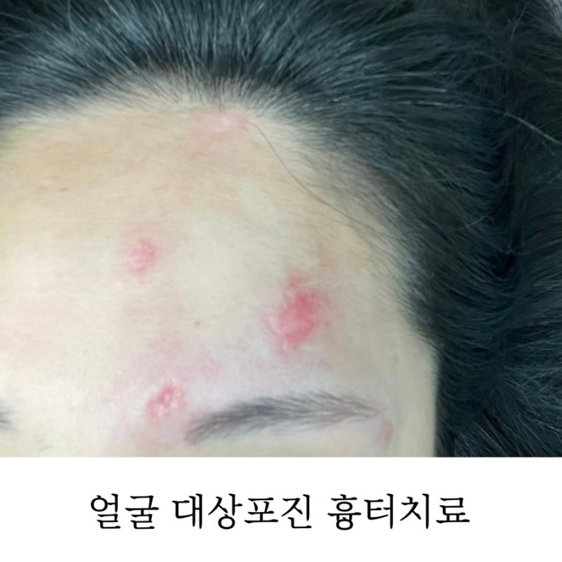 얼굴 대상포진 패인흉터 레이저 시술 4-7회차, 산후 면역력은 꼭 챙기자!