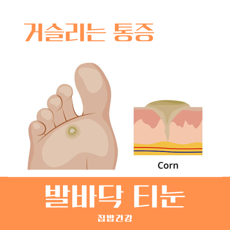 발바닥 티눈 제거 손으로 뜯거나 잘라내면 안 되는 이유