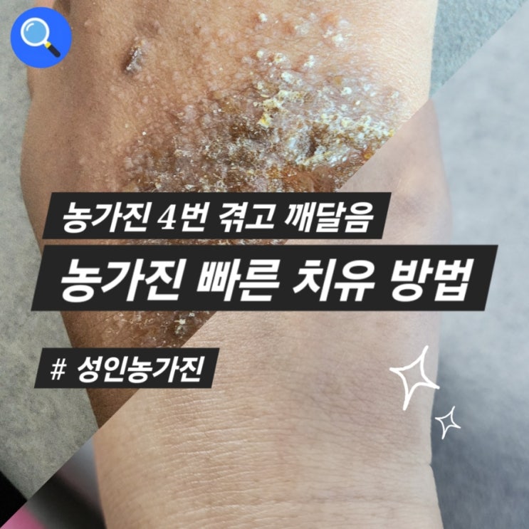  농가진 4번겪음 빠르게 낫는법 농가진치료