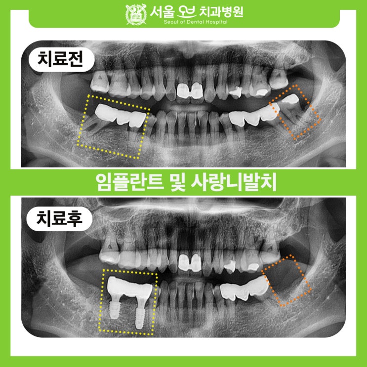  [석촌고분역치과] 신중한 치료로 임플란트를 결정했습니다.