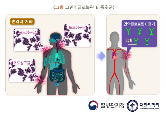 국가관리대상 희귀질환 목록 Hyper-IgE 증후군(고면역글로불린 E 증후군; 버클리 증후군)