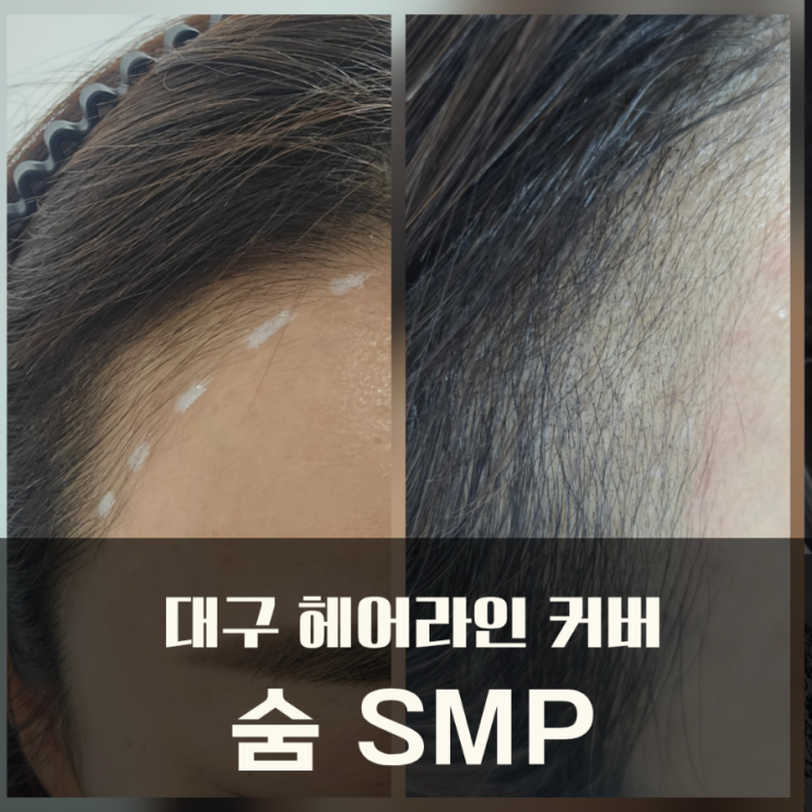  대구 SMP 북구 두피커버 헤어라인 커버 잘하는 숨 SMP