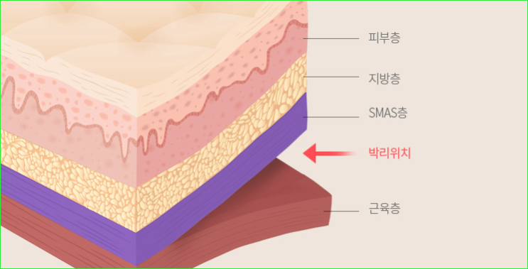 휴고성형외과 안면거상술 총정리! 안면거상 유지기간 및 붓기, 효과, 땡김이 착용 시기에 대하여