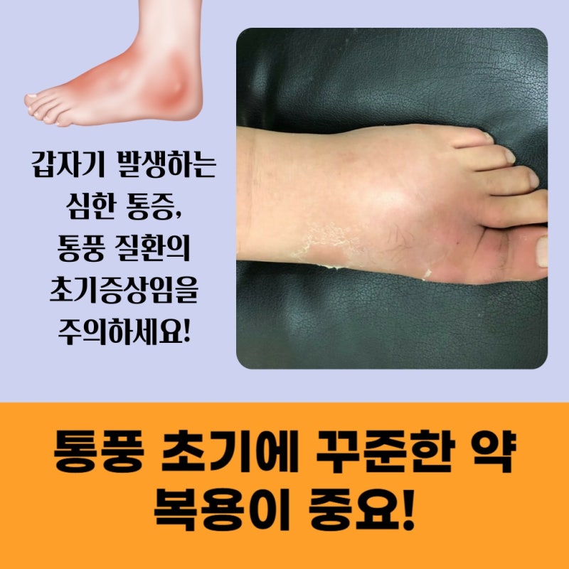 대전 통풍 검사와 치료 정확한 진단이 중요합니다