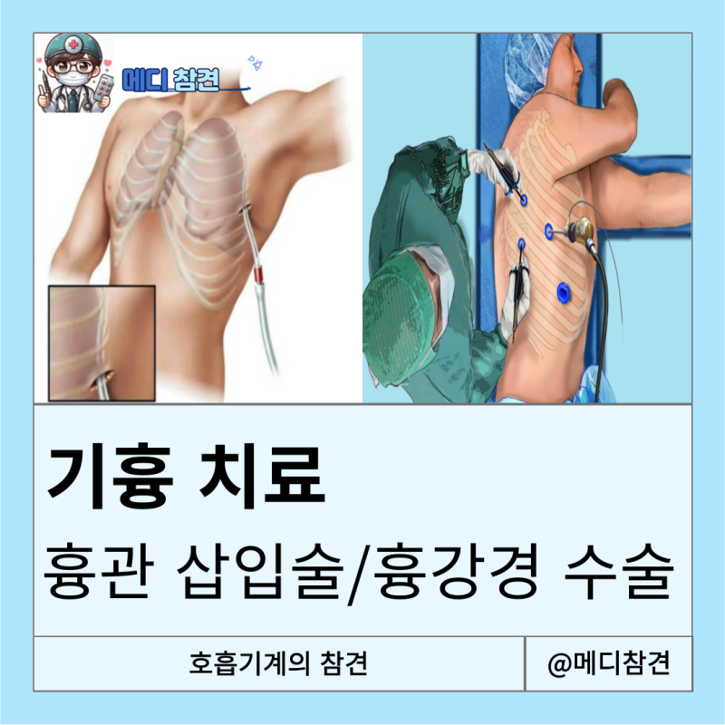 VATS 수술 의학용어 thoracostomy pneumothorax