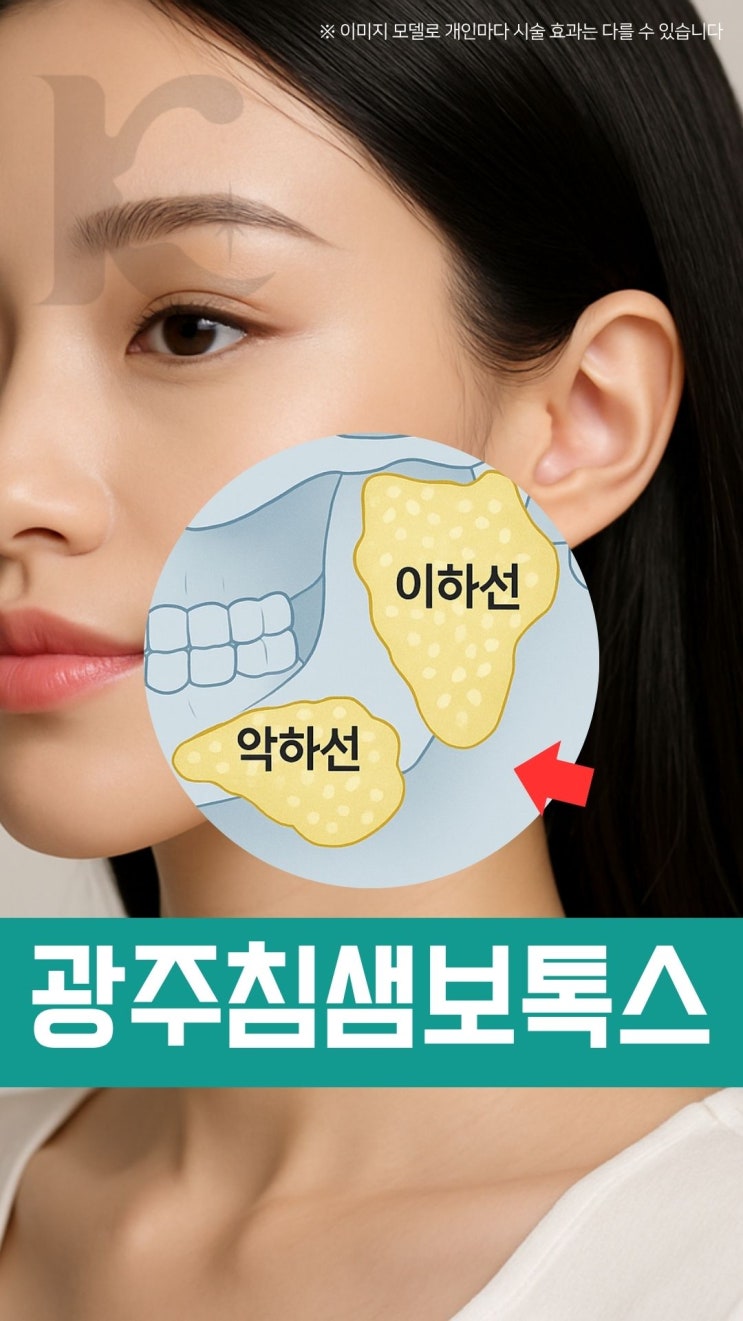  광주침샘보톡스 수완지구에서 부어오른 턱 개선하기