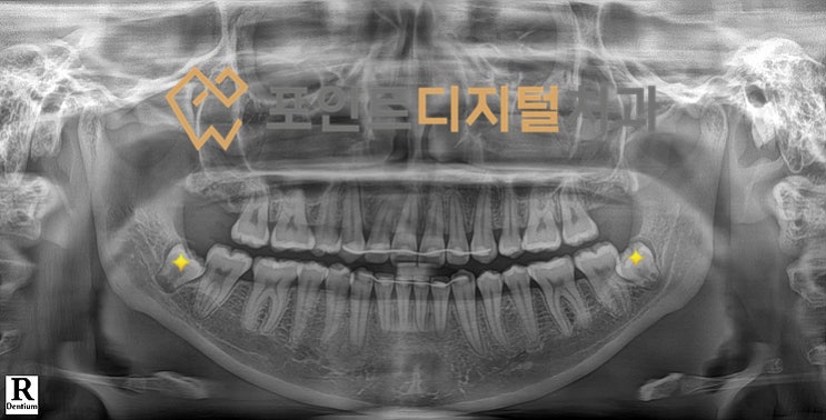  [탕정치과] 매복 사랑니 발치 / 천안 아산 불당 배방