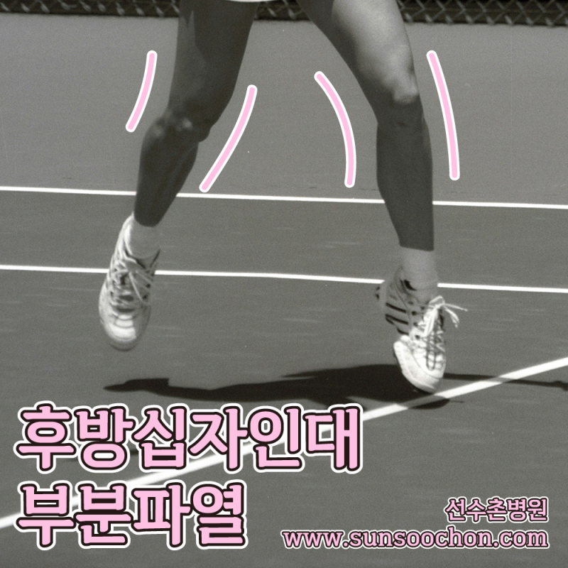 후방십자인대 부분파열, 괜찮을까?