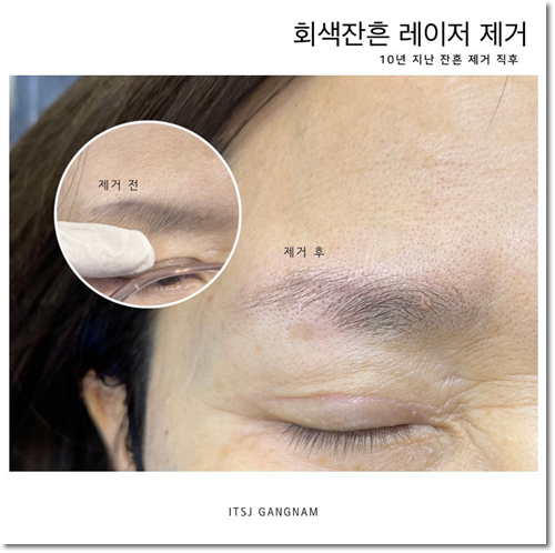  강남눈썹문신제거 솔직 경험담 후기