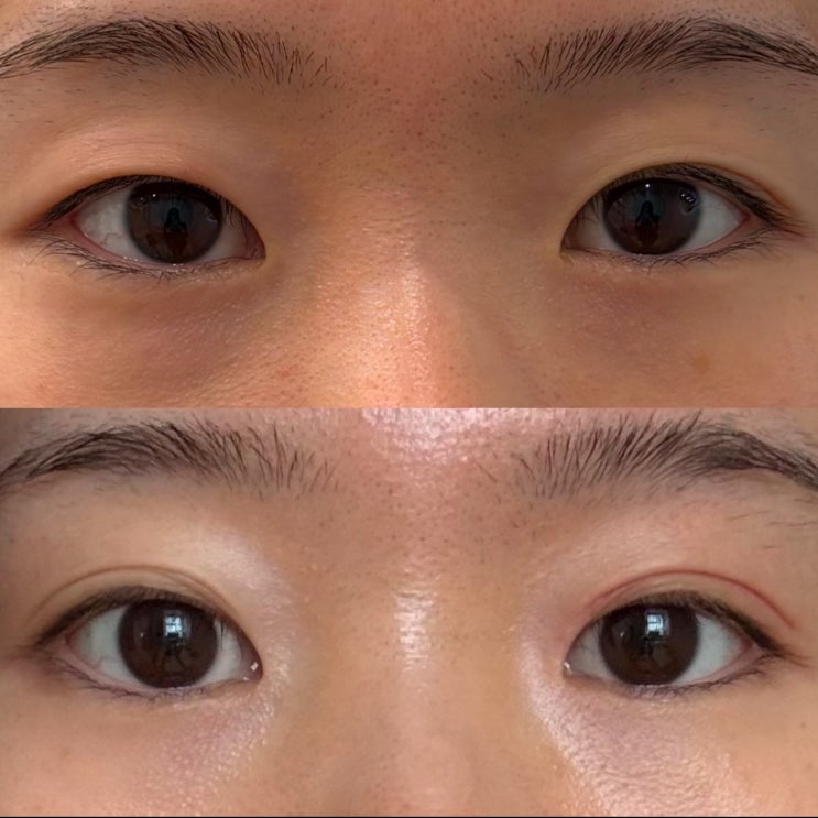  플라즈마쌍꺼풀 눈매교정 전문 부작용없이 받기 (대구아미뷰티  가격 후기 )