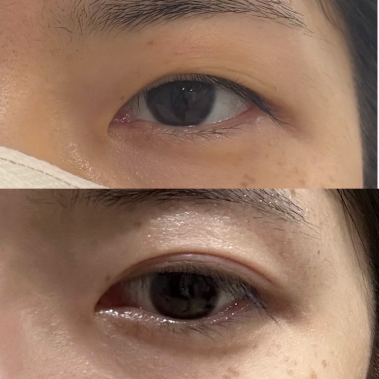  아미뷰티, 플라즈마 쌍꺼풀 눈매교정 고객님 탈각 후 리얼후기