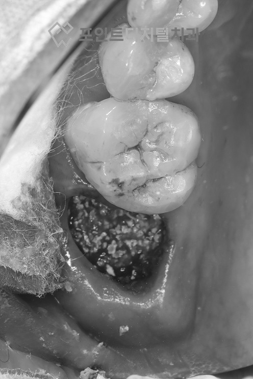  [탕정치과]  iGBR(급속골이식) + PDRN(연어주사) + 디지털 가이드 + 비절개 임플란트 / 천안 아산