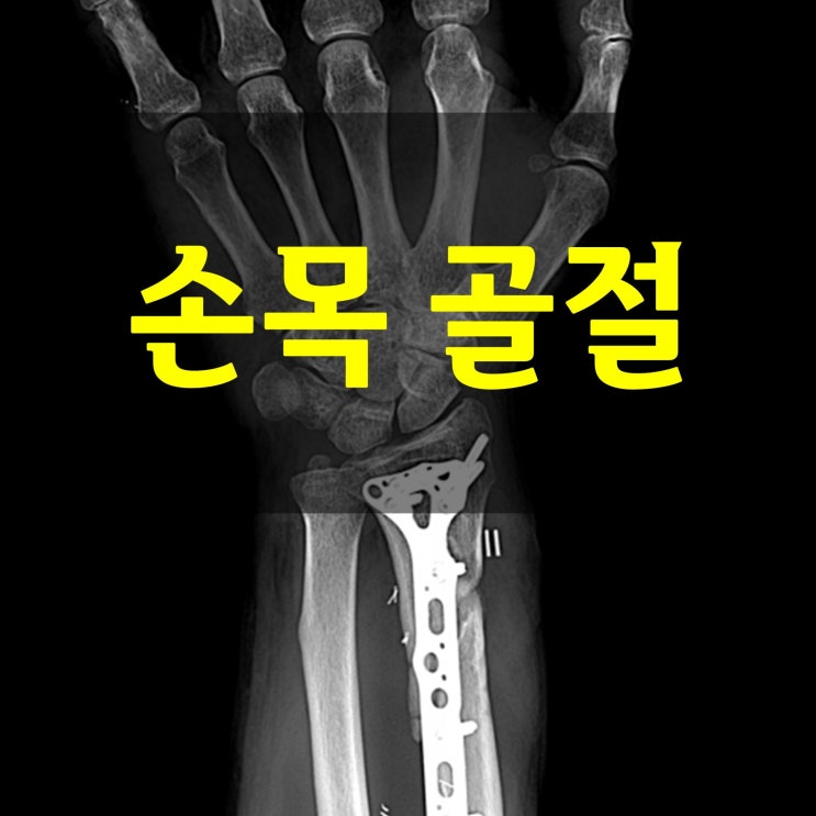  손목 골절 깁스 평균 회복기간 영양소 식단 금연