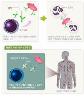 무감마글로불린혈증(브루턴병)